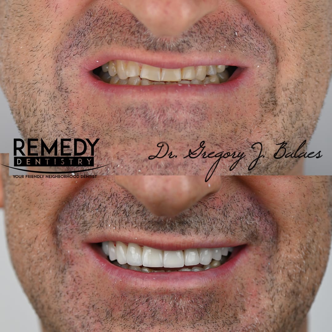 porcelain-veneers-staten-island-1