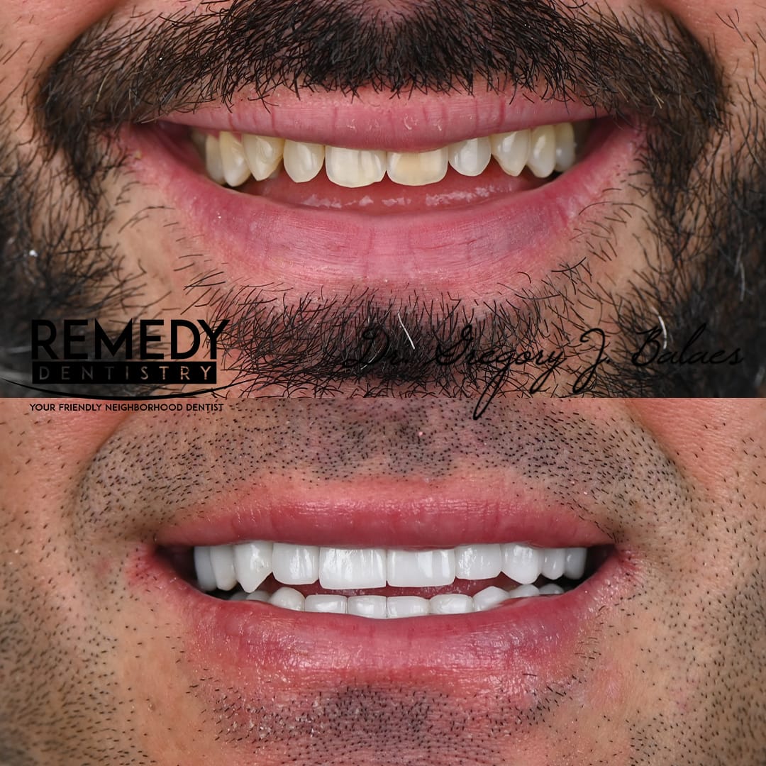 Veneers-Staten-Island-2
