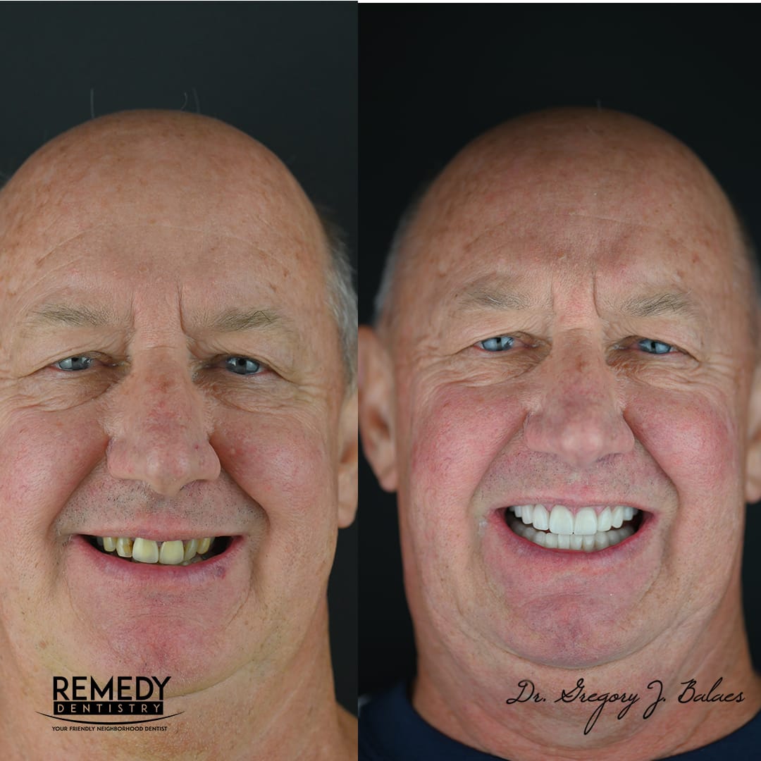 Veneers-before-after-3