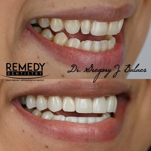 Before and after porcelain veneers smile makeover at Remedy Dentistry in Staten Island