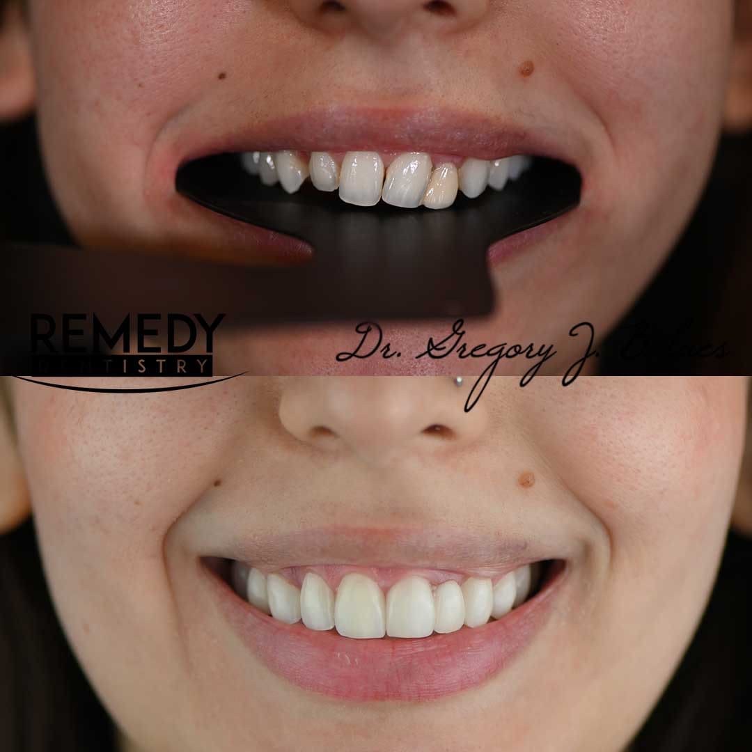 Natural smile makeover before and after at Remedy Dentistry