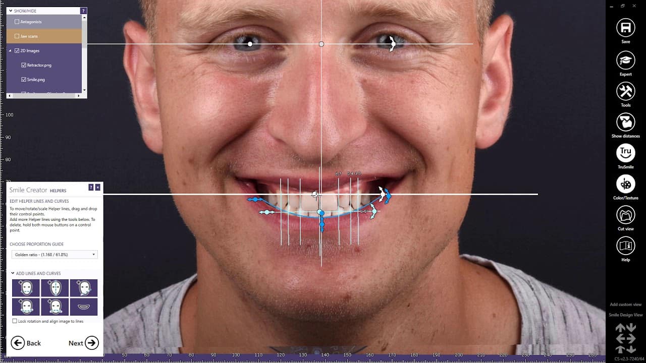 Digital smile-planning screen with facial reference lines and proposed tooth proportions