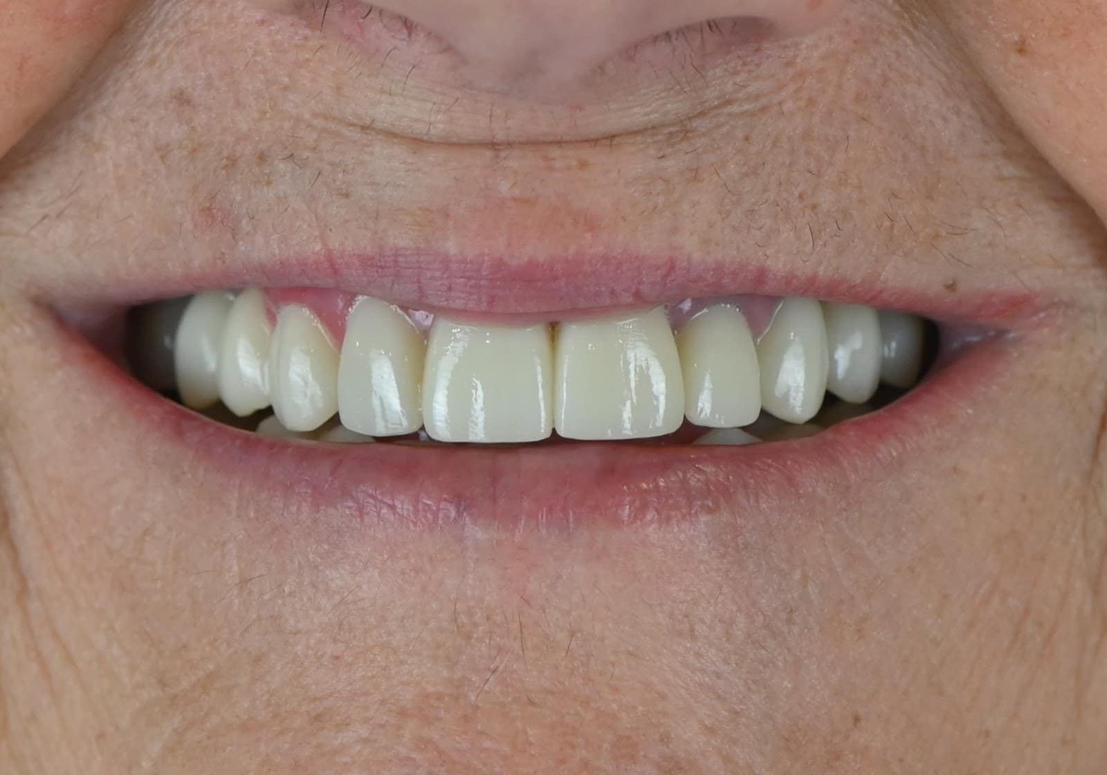 Close-up of the final smile, showing brighter teeth and more even front-tooth edges